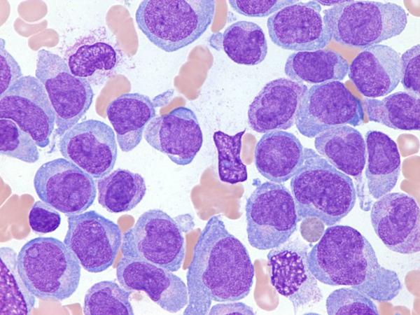 Acute myeloid leukemia